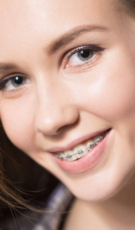 Orthodontie Amsterdam Jeugd meisjemetbeugel